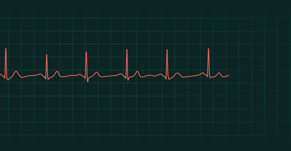 A Universal, High-performance EKG Signal Processing Engine To Reduce ...